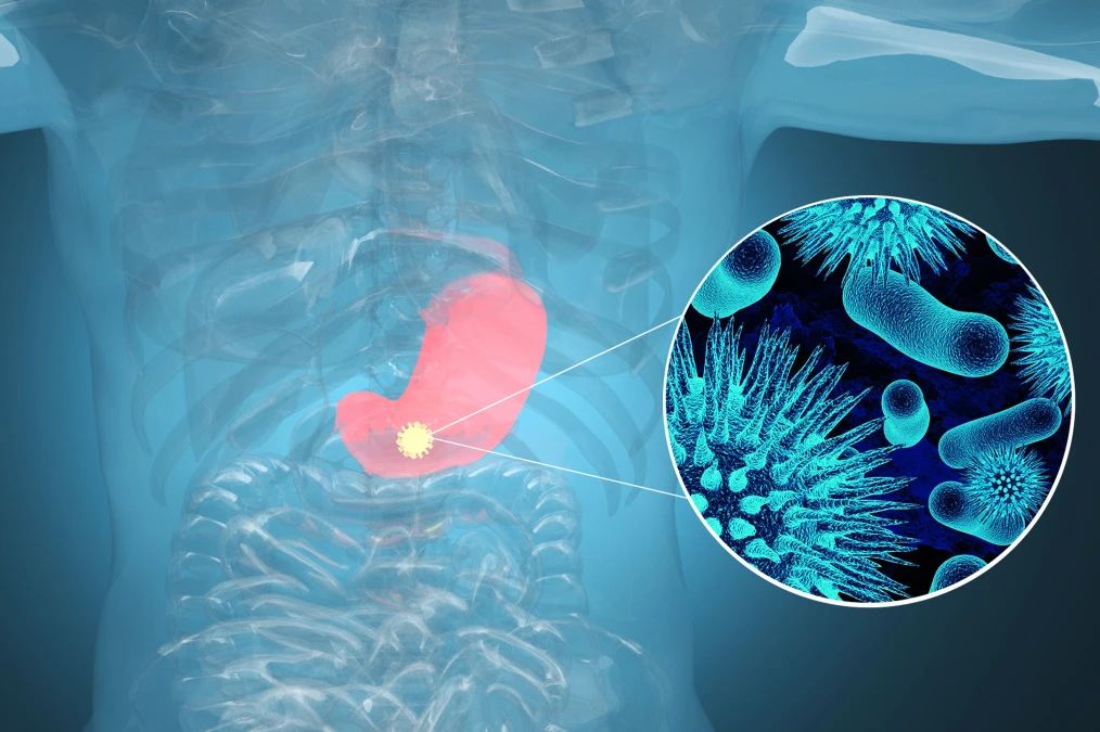 肿瘤标记物CA72-4：“胃”，你还好吗？